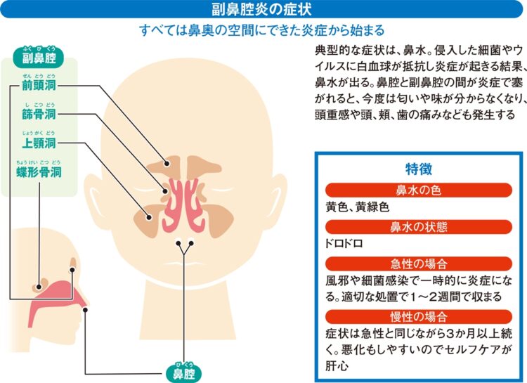 副鼻腔炎の症状