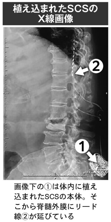植え込まれたSCSのX線画像
