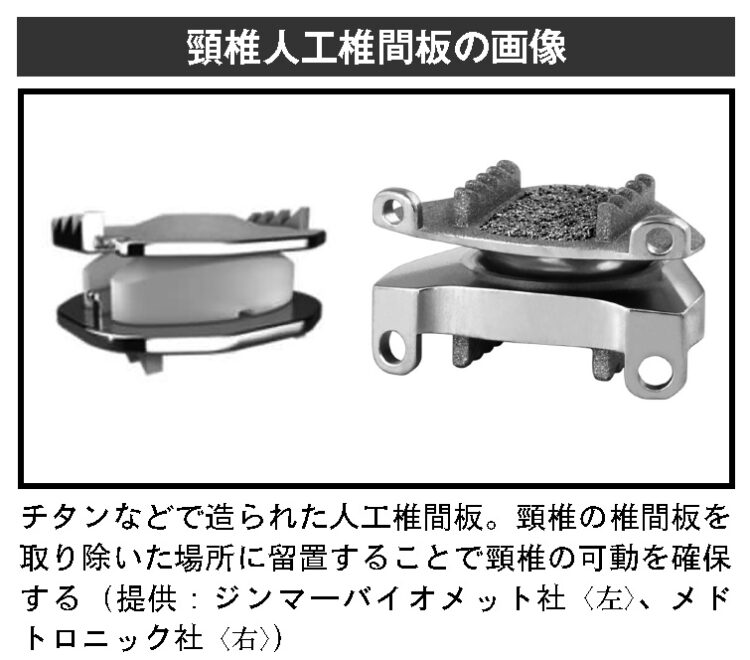 頸椎人工椎間板の画像