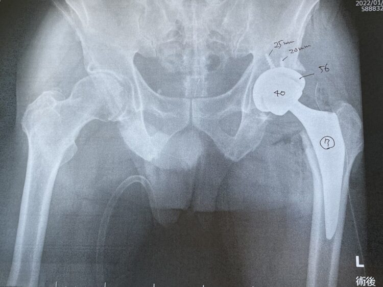 今年1月に手術した加藤晴之氏の左股関節は骨が削り取られ、代わりに「人工股関節」が入れられている（写真提供／加藤氏）