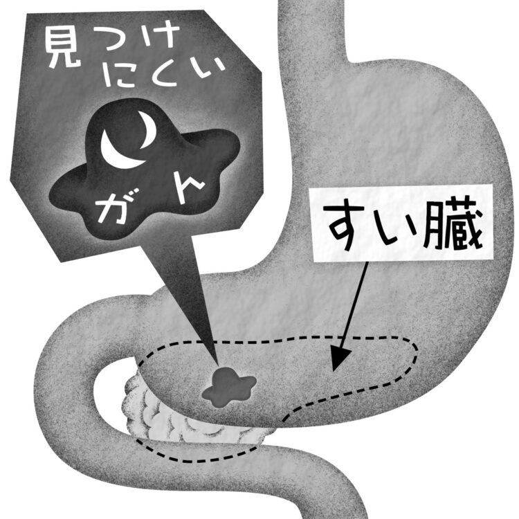 すい臓がんの早期発見は難しいとされてきた