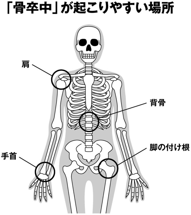 「骨卒中」が起こりやすい場所