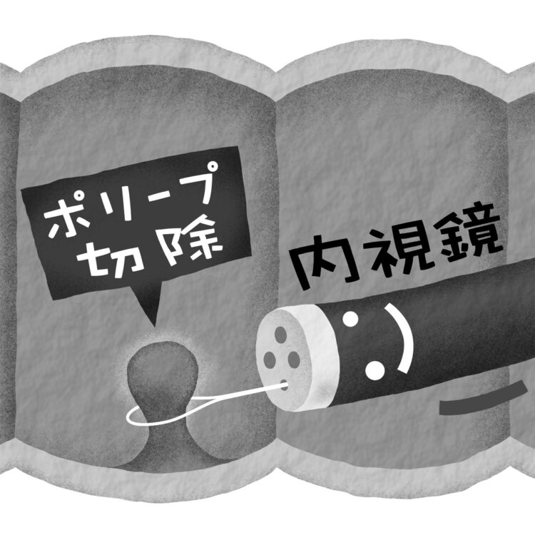 「NBI拡大内視鏡」で可能になったがんかポリープかを判断