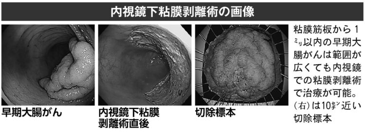 内視鏡下粘膜剥離術の画像