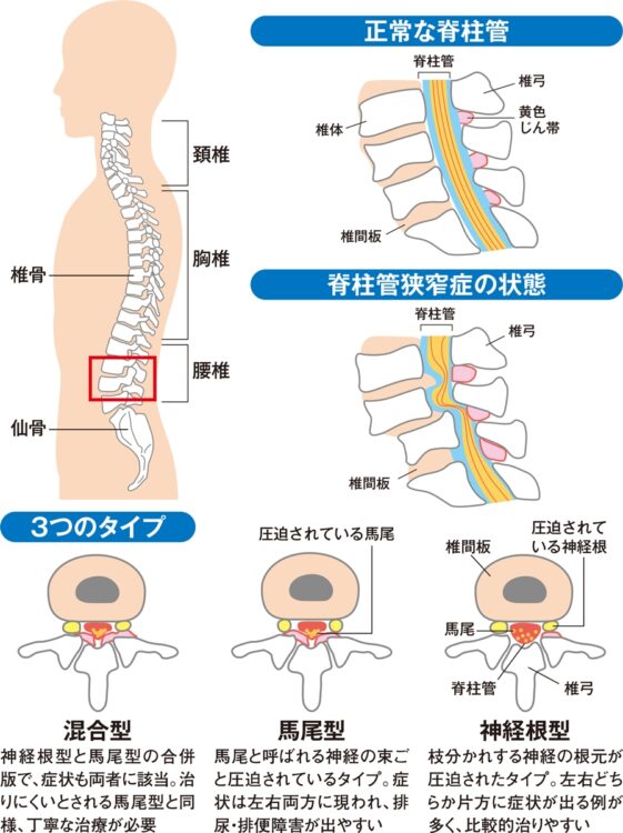 脊柱管狭窄症とは？