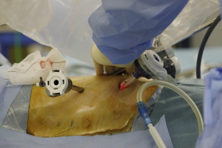 手術支援ロボット「ダ・ヴィンチ」では、脇の下あたりに1～2センチ程度の穴を開けて、カメラや鉗子を挿入する。開胸手術に比べて傷が小さく、患者の負担が少ない