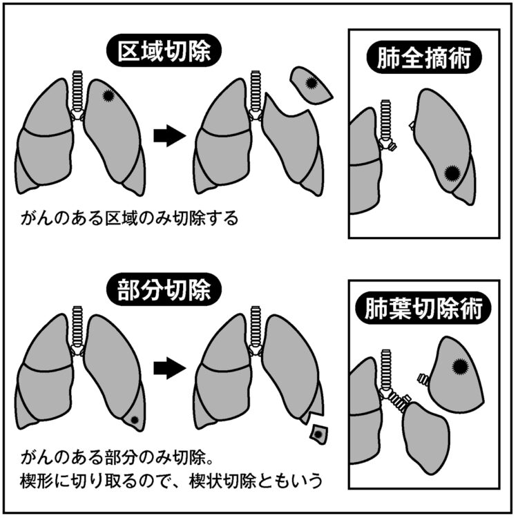 肺がんの手術は今回行なわれた肺葉切除のほか、肺を部分的に切除する縮小手術もある。患者負担が少ない一方、難易度が高い。鈴木氏はリスクの高い手術も積極的に手がけている