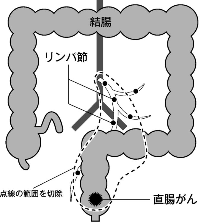 直腸がん付近の腸管と転移の可能性があるリンパ節を切除し、その後、残った腸管を肛門側の腸管とつなぎ合わせる直腸がん手術