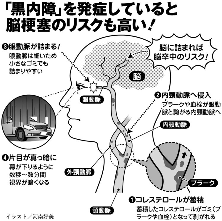 「黒内障」を発症していると脳梗塞のリスクも高い