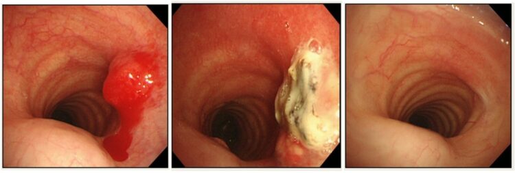 他病院で10年前に甲状腺がん手術を受けた患者に血痰が出現し、気管内に浸潤するがんが見つかった。紹介を受けた筒井医師が気管支鏡下腫瘍焼灼術を実施。【上】治療前。【中】焼灼後1か月。がんが凝固・縮小している。出血のリスクが減ってから分子標的薬治療を開始。【下】焼灼後12か月、分子標的薬治療開始後10か月。がんは消え、治療部の気管粘膜は再生し滑らかになった