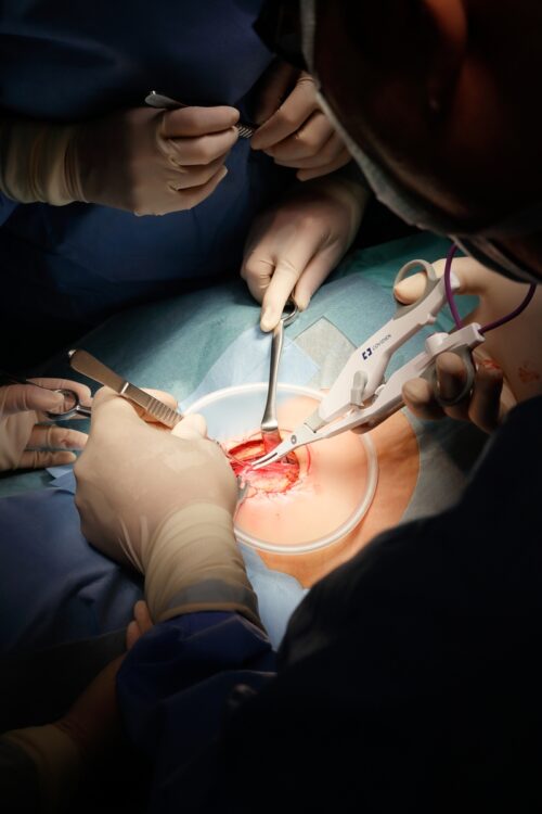 手術野は径5センチと狭い。筒井医師が持つ白いハサミ状のものが最新のエナジーデバイス。出血させずに剥離・凝固・切開ができ、合併症を防ぐ効果が高い