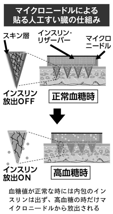 マイクロニードルによる貼る人工すい臓の仕組み