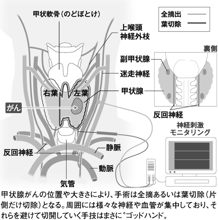 甲状腺がんの位置や大きさにより、手術は全摘あるいは葉切除（片側だけ切除）となる