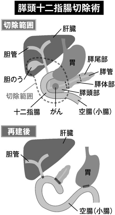 膵頭十二指腸切除術