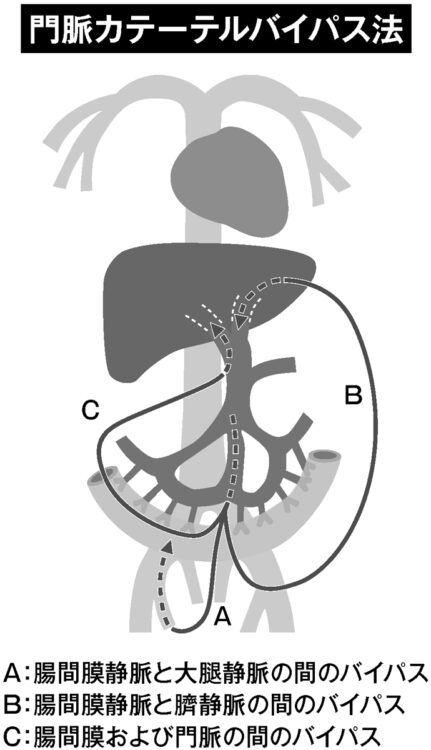 門脈カテーテルバイパス法