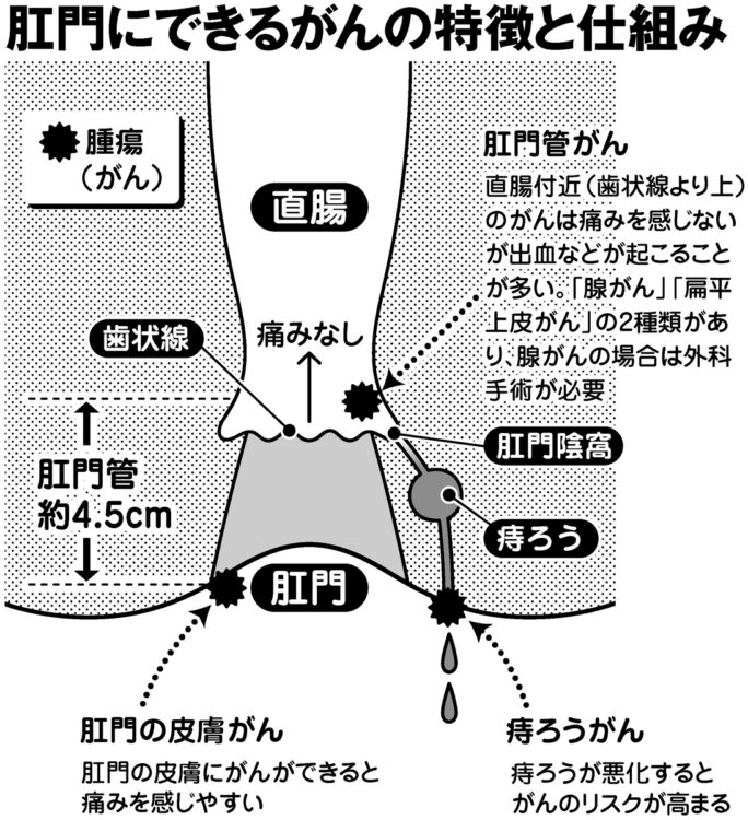 肛門にできるがんの特徴と仕組み