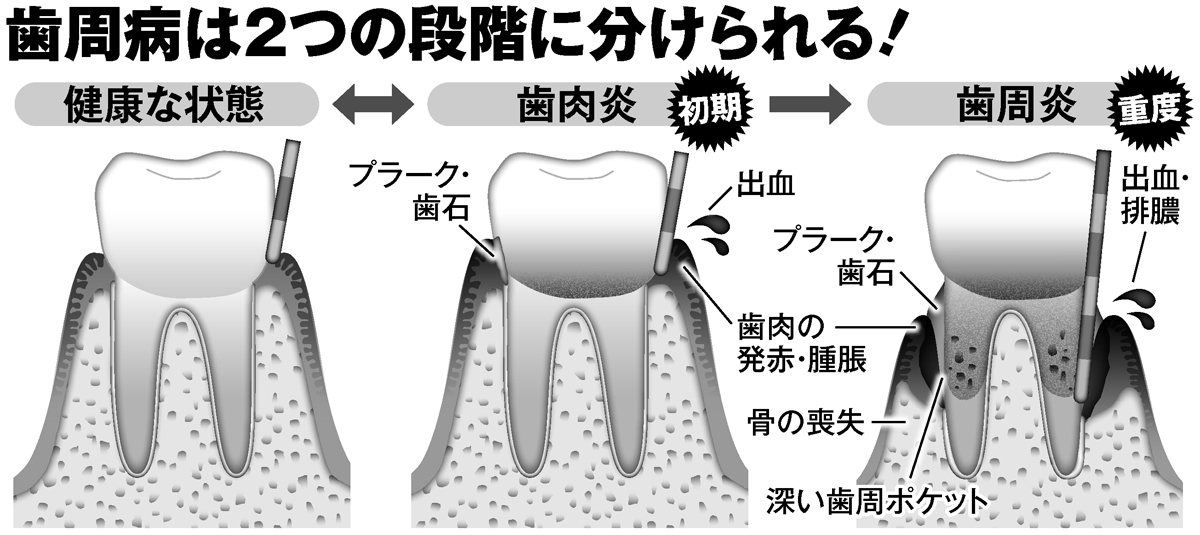 歯周病は2つの段階に分けられる