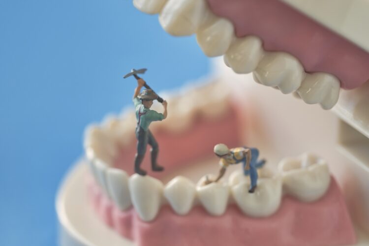 虫歯治療の注意点は？（イメージ）
