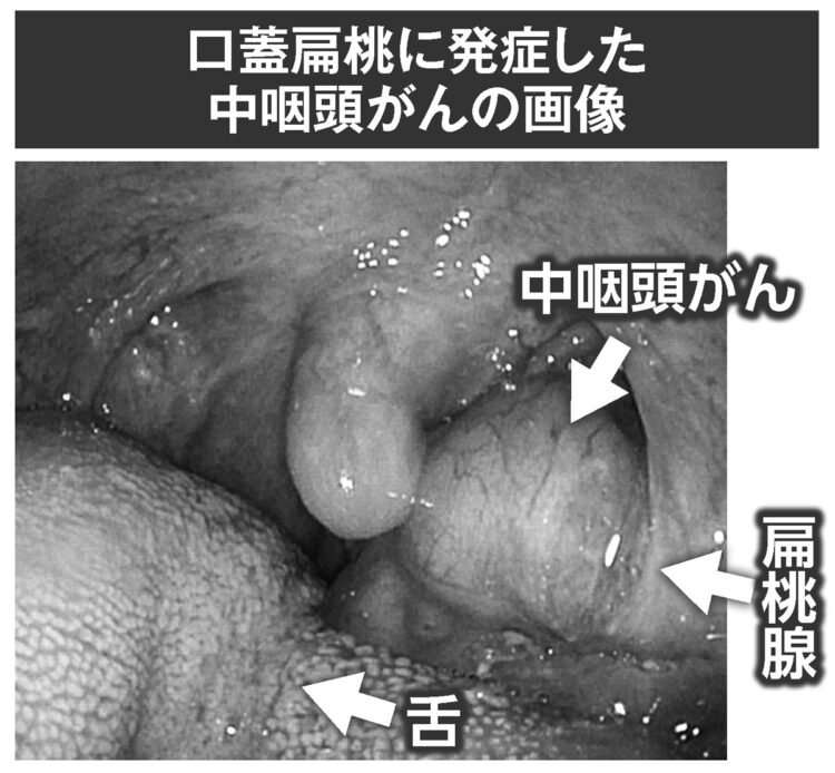 口扁桃腺に発症した中咽頭がんの画像