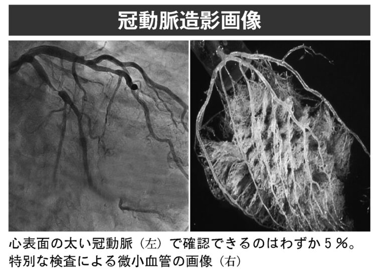 冠動脈造影画像