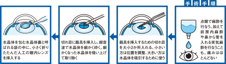 手術手順