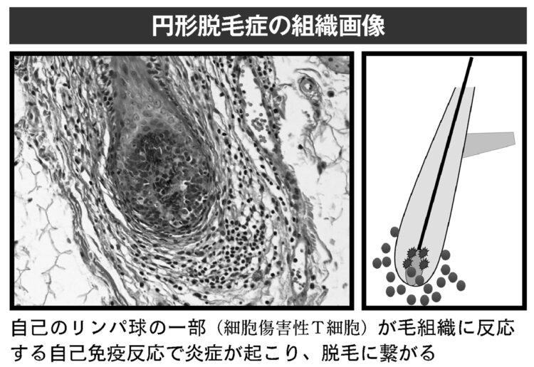 円形脱毛症の組織画像