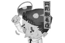 自己免疫疾患の一つ「円形脱毛症」（イラスト／いかわやすとし）