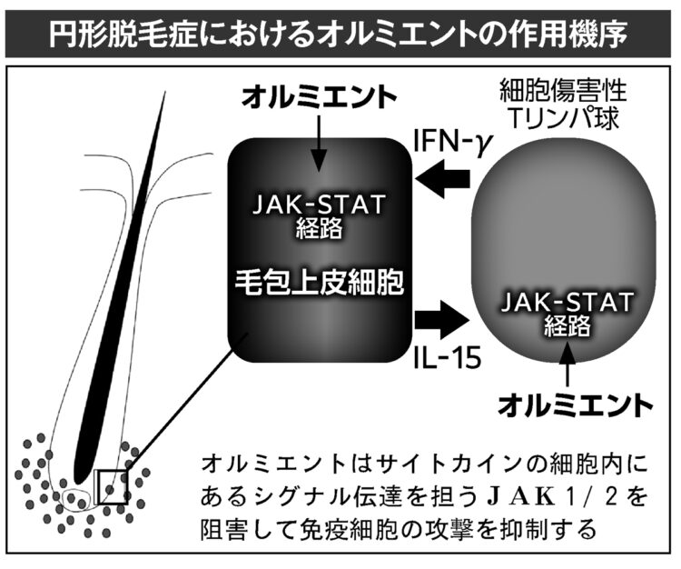 円形脱毛症におけるオルミエントの作用機序