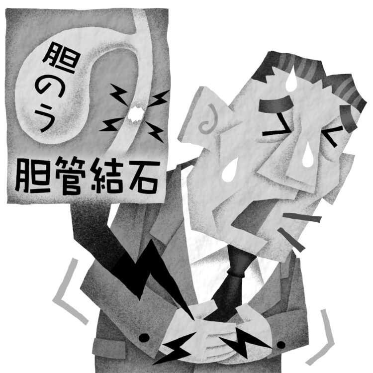 「胆道鏡電気水圧衝撃波治療」を実施できる国内の施設も増えてきている（イラスト／いかわやすとし）