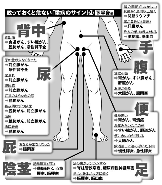 放っておくと危ない「重病のサイン」21（下半身編）