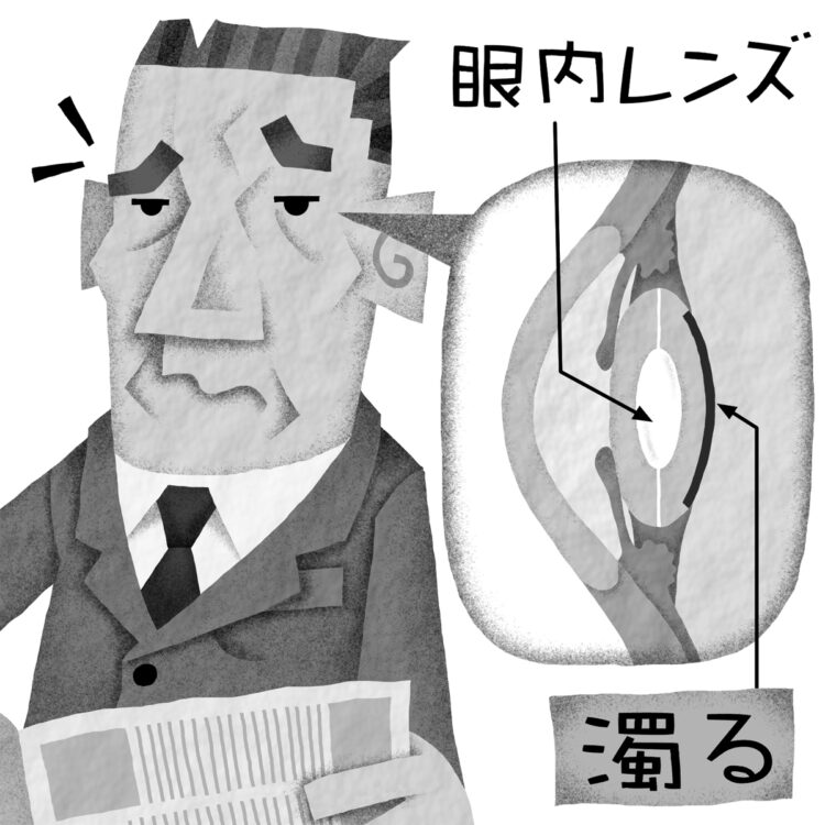 「後発白内障」はYAGレーザーで完治（イラスト／いかわやすとし）