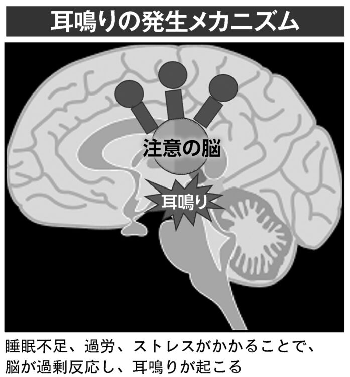 耳鳴りの発生メカニズム