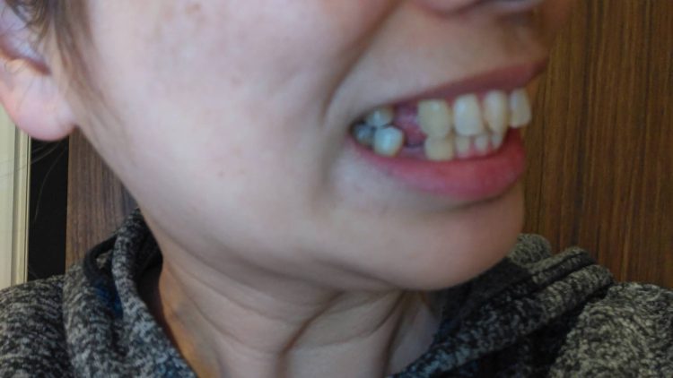 被害者の中には治療前より歯列が悪くなった人も（提供写真）