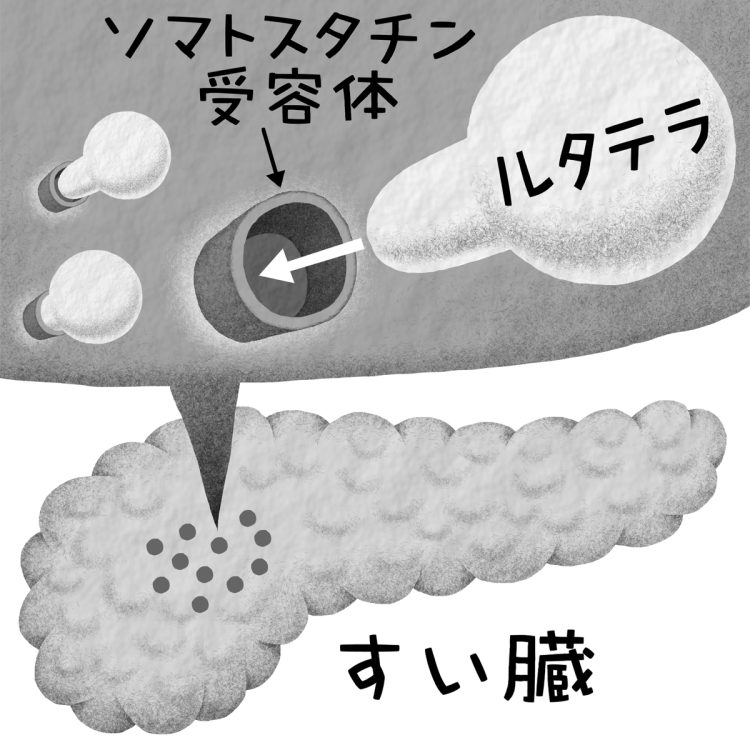 神経内分泌腫瘍はどう治療する？（イラスト／いかわやすとし）