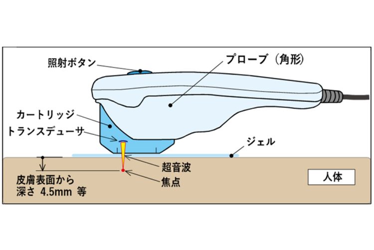 ハイフ照射のイメージ。出典／消費者庁 消費者安全調査委員会