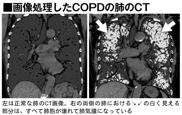 画像処理したCOPDの肺のCT