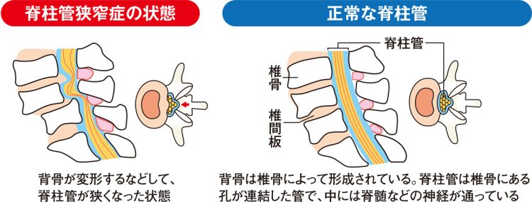 脊柱管狭窄症の状態と正常な脊柱管