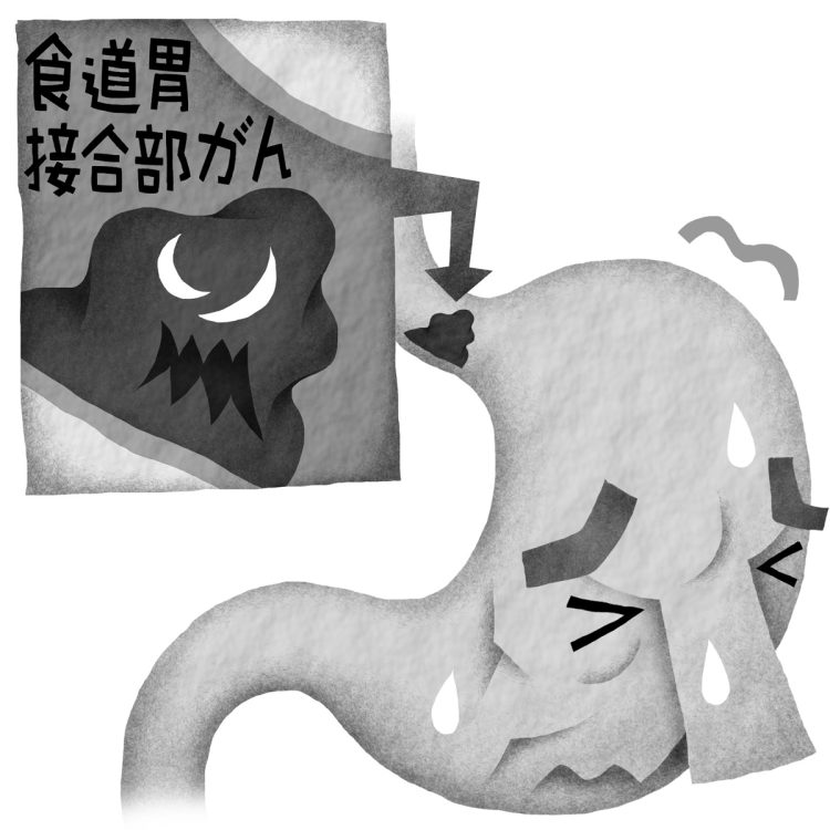 弁形成術は術後の逆流抑制に役立つという（イラスト／いかわやすとし）