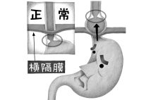 食道裂孔が緩んで広がり、胃の一部が胸部に飛び出す「食道裂孔ヘルニア」(イラスト/いかわやすとし)