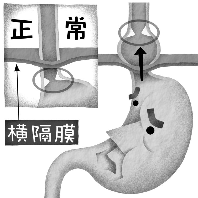 食道裂孔が緩んで広がり、胃の一部が胸部に飛び出す「食道裂孔ヘルニア」（イラスト／いかわやすとし）