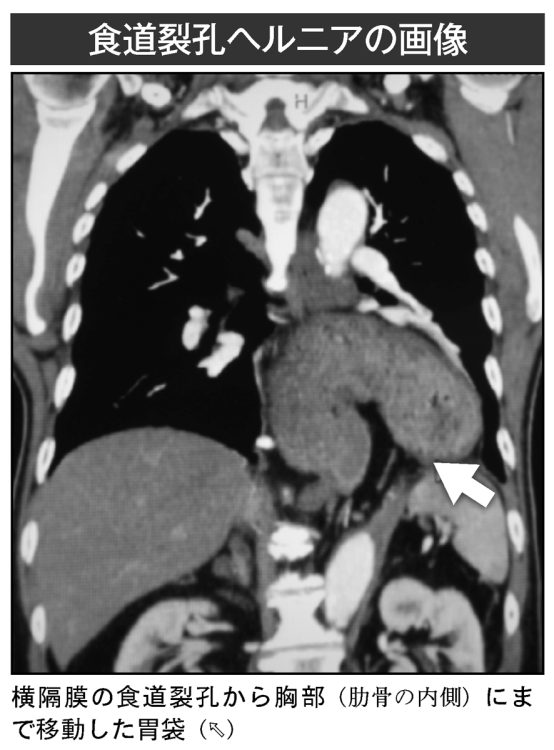 食道裂孔ヘルニアの画像