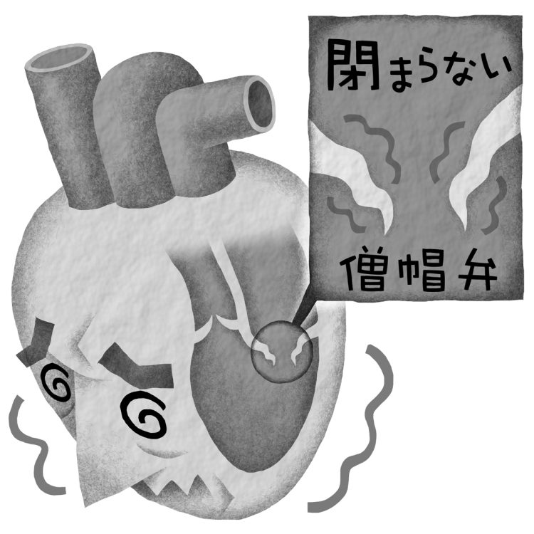 放置すると息切れが激しくなって歩けなくなる「僧帽弁閉鎖不全症」（イラスト／いかわやすとし）