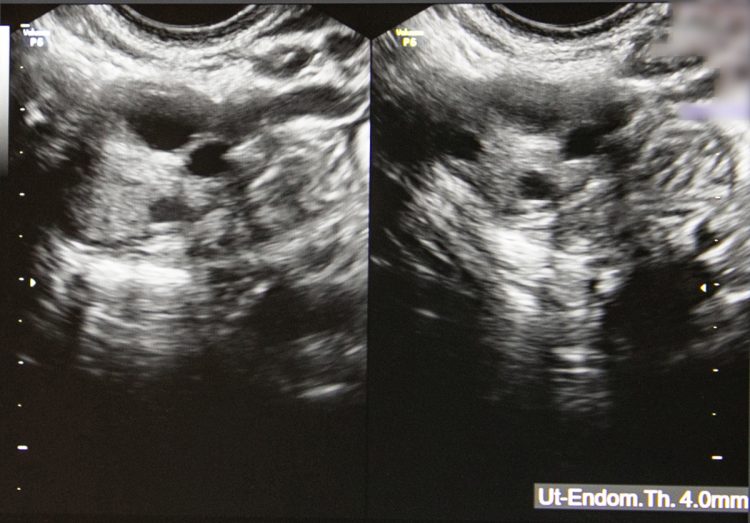 左右の子宮内を超音波で確認。この日は生理開始数日後で、黒く丸い部分が、卵子が入った卵胞。「大きさのばらつきはありますが、これから卵胞を育てる薬剤で卵巣を刺激して、採取できる大きさまで育てていきましょう」と小松院長