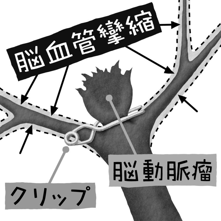 くも膜下出血の止血治療後、2週間以内に発症する頻度が高いのが、脳血管攣縮による脳梗塞（イラスト／いかわやすとし）