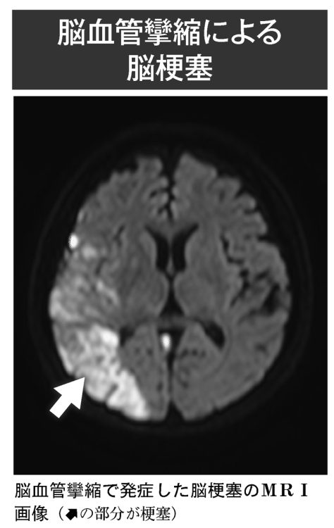 脳血管攣縮による脳梗塞