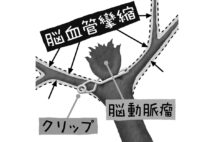 くも膜下出血の止血治療後、2週間以内に発症する頻度が高いのが、脳血管攣縮による脳梗塞（イラスト／いかわやすとし）