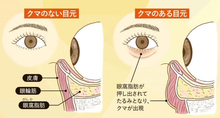 「クマのない目元」と「クマのある目元」