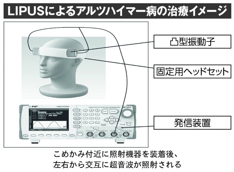 LIPUSによるアルツハイマー病の治療イメージ