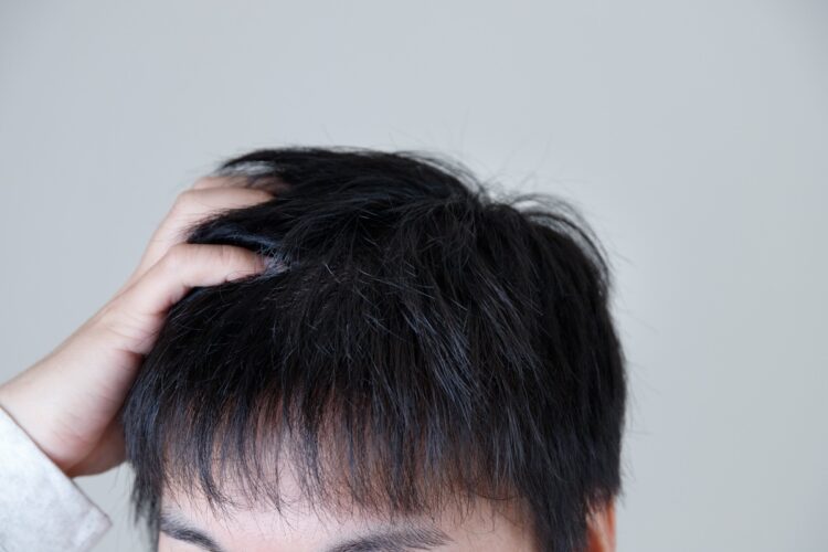 中年以降の男性の薄毛は「栄養不足」や「ホルモンバランス」が理由のことも（イメージ）