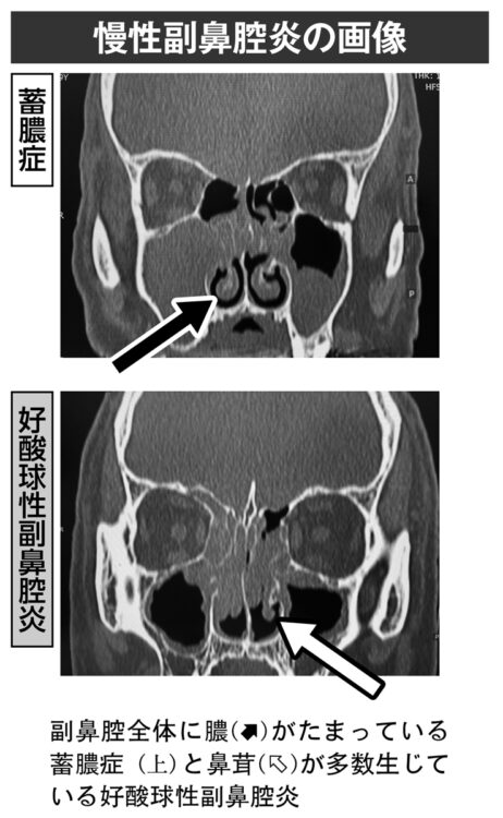 慢性副鼻腔炎の画像